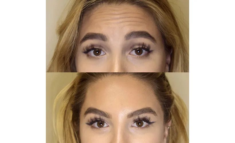 can you get botox on glp 1 results alter while GLP-1 weight-loss drugs, study says Preventative Microneedling & Botox for