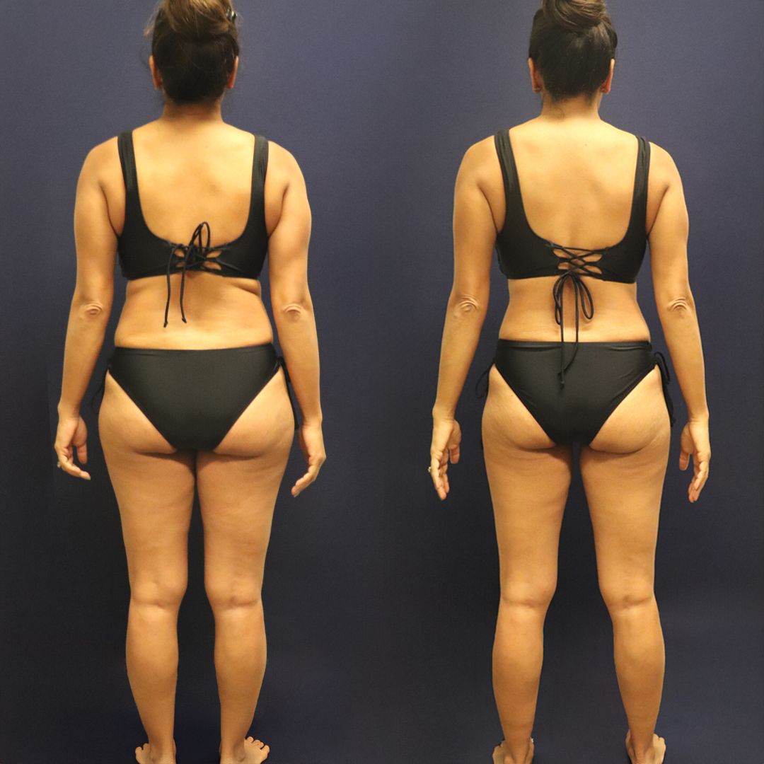 Who Should Consider Weight Loss Injections?