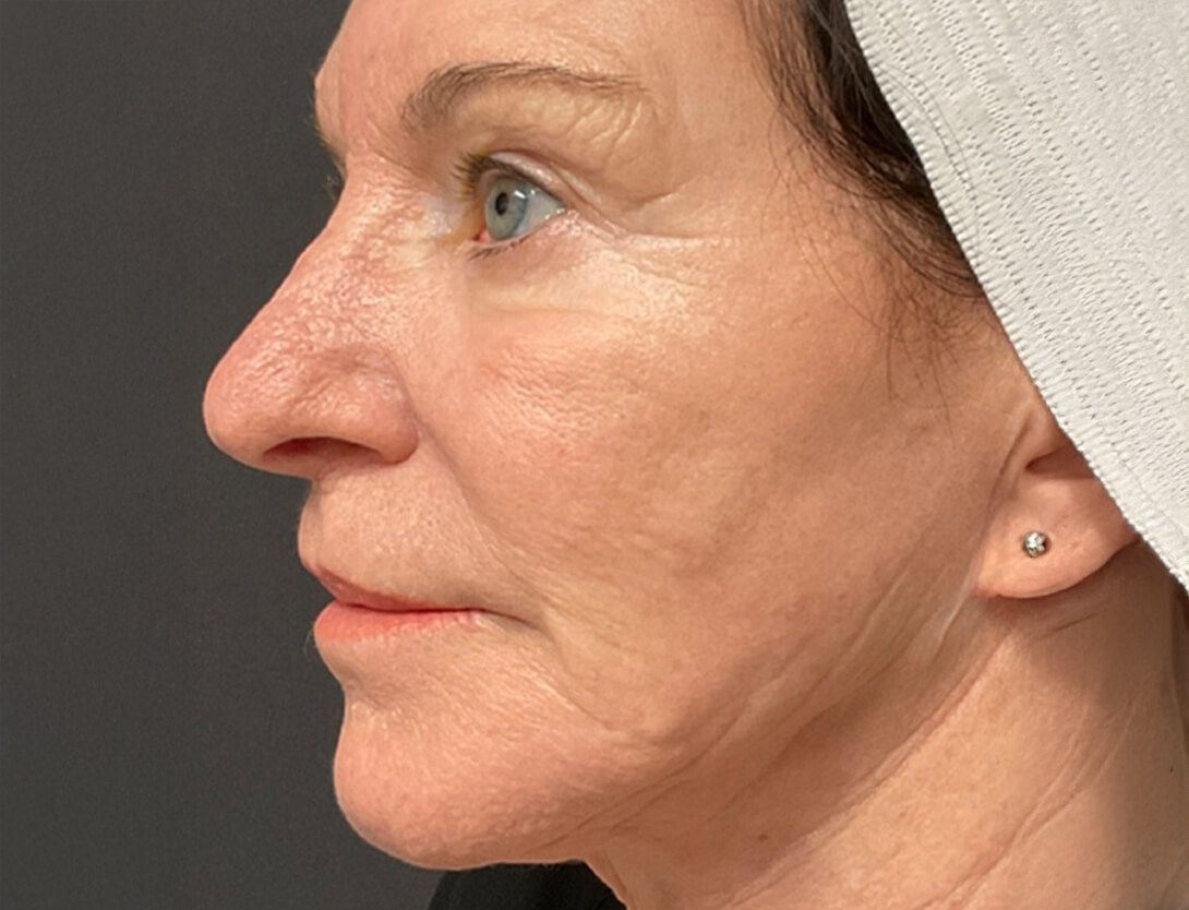 Morpheus8 in Orange County, CA | Revive Med Spa